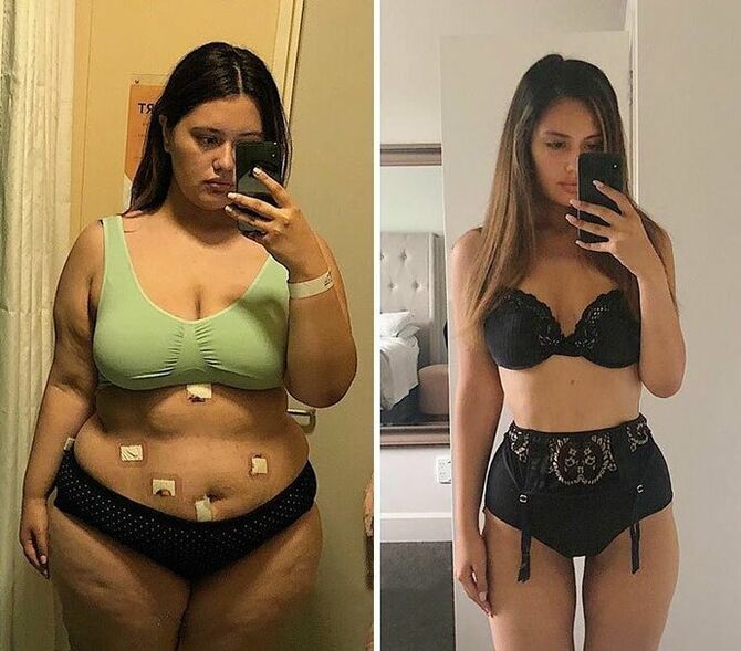 دختر قبل و بعد از کاهش وزن با کپسول KETO Complete